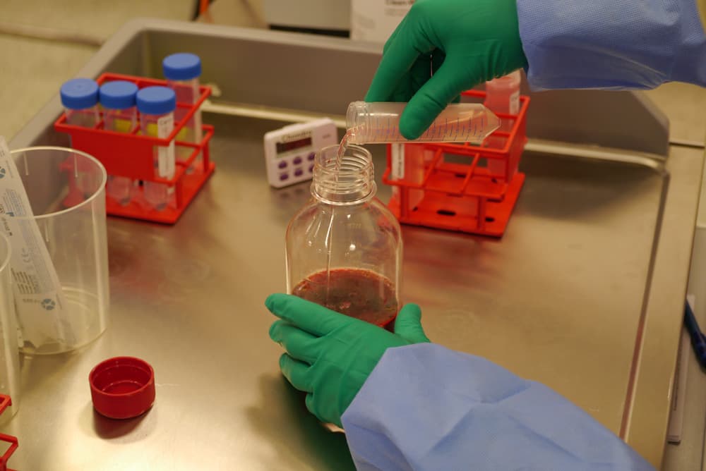 NanoACi cartilage injection prepared at London Cartilage Clinic in London