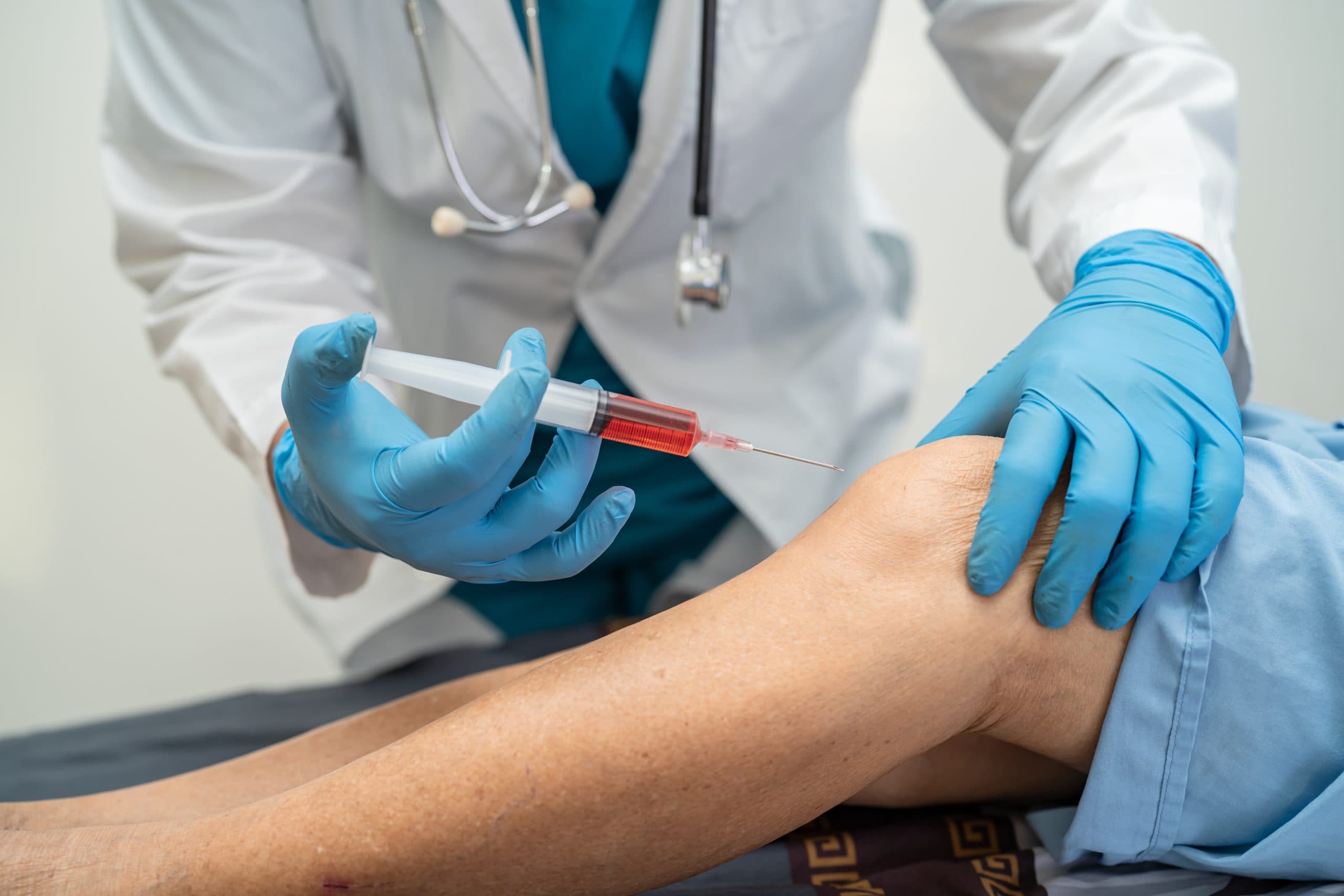 Red PRP syringe prepared for knee injection